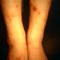tuberculid_papulonecrotic2-1139.jpg
