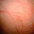 urticaria.jpg