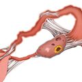 uterine_adhesion.jpg