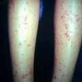 vasculitis.jpg
