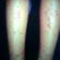 vasculitis2.jpg