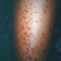 vasculitis3.jpg