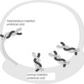 velamentous_umbilical_cord_insertion-122710.png
