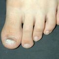 verruca_naildystrophy010924-1.jpg