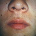 verrucamulti2.jpg