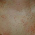 verrucaplana010322.jpg