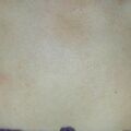 verrucaplana020506-2.jpg