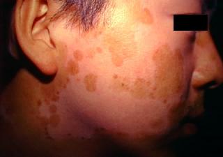 vitiligo11.jpg