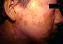 med:vitiligo11.jpg