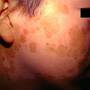 vitiligo11.jpg