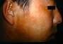 med:vitiligo13.jpg
