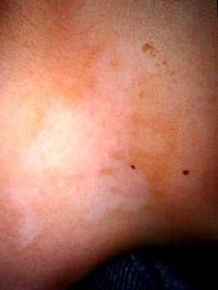 vitiligo8-199.jpg