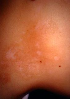 vitiligo8-820.jpg