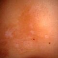 vitiligo8-820.jpg