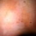 vitiligo_graft1.jpg