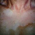 vitiligo_puva6-388.jpg