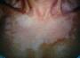 med:vitiligo_puva6-388.jpg