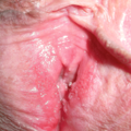 vulvar_vestibular_papillomatosis-164748.png