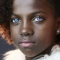 waardenburg_syndrome-142242.png