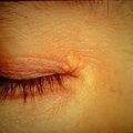 xanthelasma4-1160.jpg