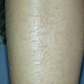 xeroticeczema011214-1.jpg