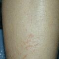 xeroticeczema011214-2.jpg