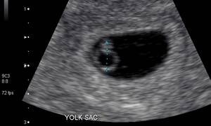As the pregnancy advances, the next structure to become visible to ultrasound is the yolk sac. This is a round, sonolucent structure with a bright rim. 